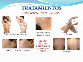 Depilación total con IPL