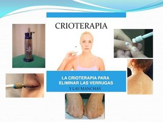 Crioterapia