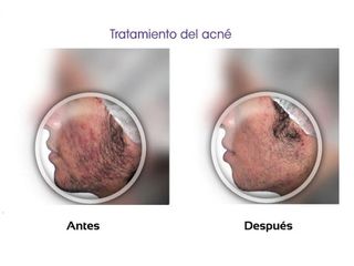 Tratamientos anti acné