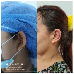 Otoplastia - Dra. Natalia Reyes