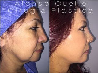 ESTIRAMIENTO FACIAL