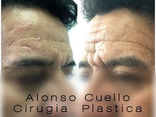 BOTOX + ACIDO HIALURONICO