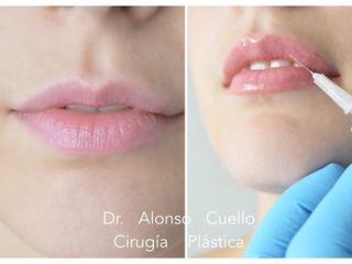 RELLENO DE LABIOS CON ACIDO HIALURONICO