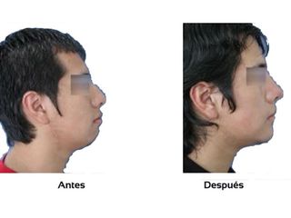 Mentoplastia