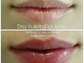 Perfilado y relleno de labios