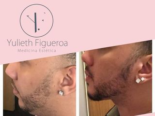 PERFILAMIENTO FACIAL Bichectomia, Lipopapada y relleno de Mentón