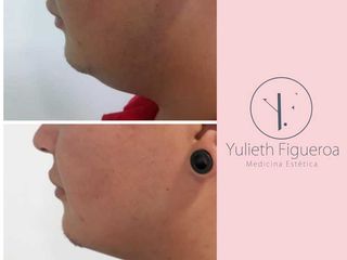 PERFILAMIENTO FACIAL Bichectomia y lipopapada
