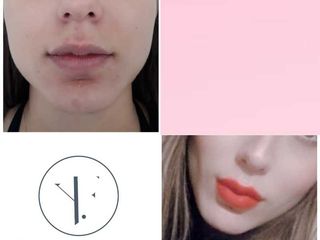 PERFILAMIENTO FACIAL Bichectomia
