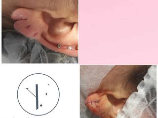 REPARACIÓN DE LOBULO DE LA OREJA Lobuloplastia