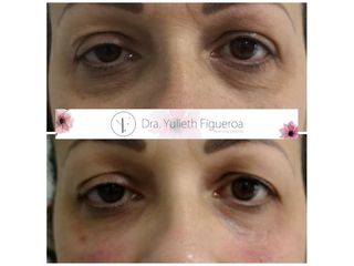 Eliminación de ojeras