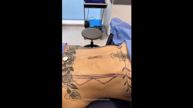 Liposucción - Dr. Darío Jurís