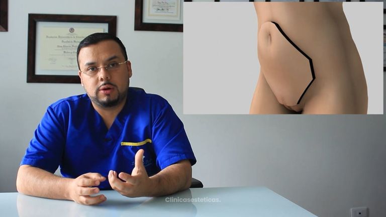 Lipoabdominoplastía.