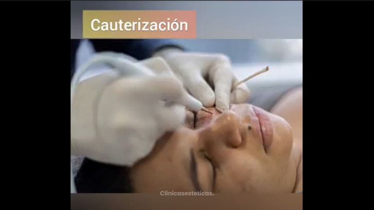 Proceso de  Cauterización